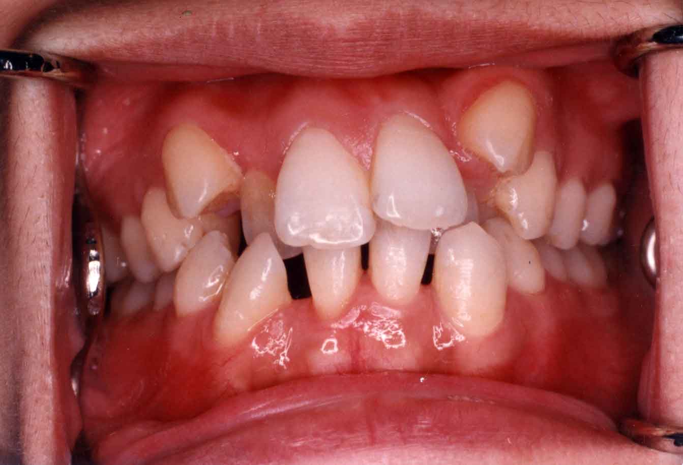 北京牙齿矫正林琳案例分享：深覆合深覆盖，牙齿前突，牙齿拥挤 - 知乎